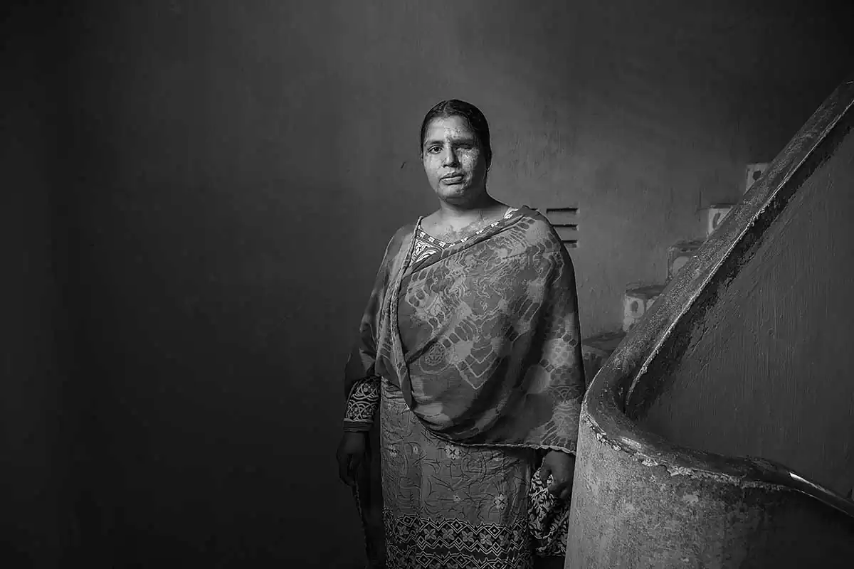 Suraiya, 28 y.o., is a survivor. Attacked by her husband for dowry, she had a facial disfigurement and posted her one eyesight. She denounced her aggressor (perpetrator in in prison life time) and after physical treatment and psychological service at Acid Survivors Foundation in Dhaka, she started to work as survivor ambassador for help other women in same conditions. Suraiya was award from Ministry of Women's Affair of Bangladesh for her courage.