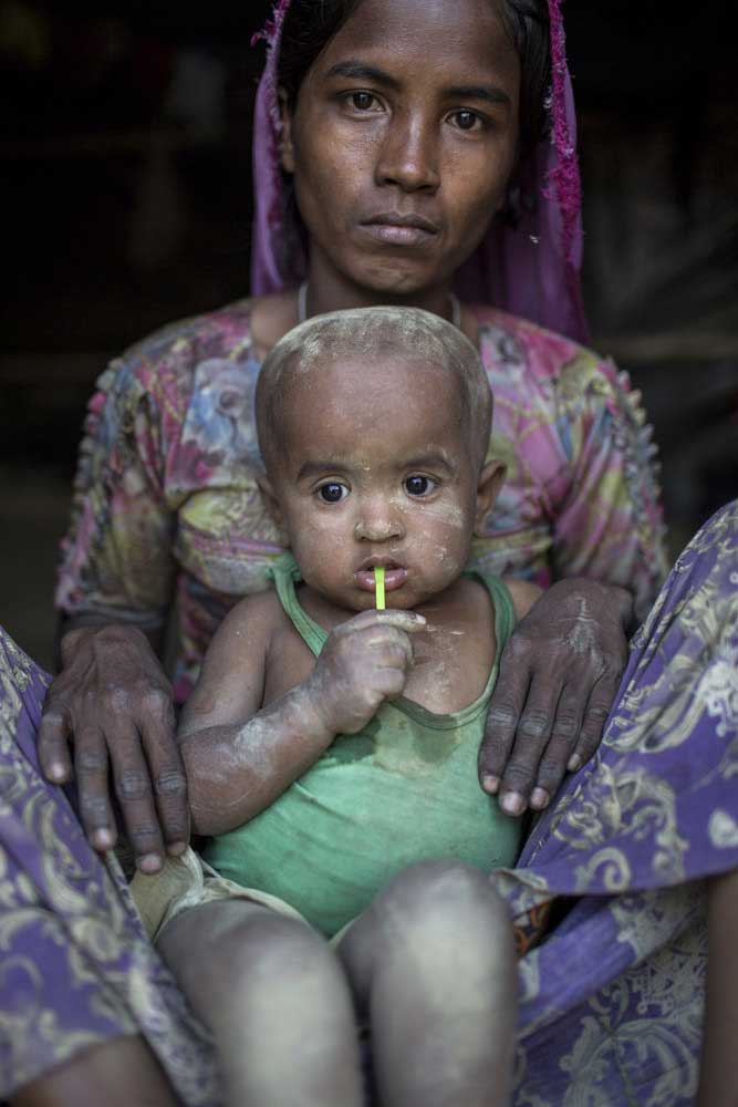 A distressed mother, Anwara Begum, 30, holds her daughter Rozina who suffers from malnutrition. Anwara who fled from violence against Muslims in Myanmar, found new shelter in Kutupalong Rohingya refugee camp.