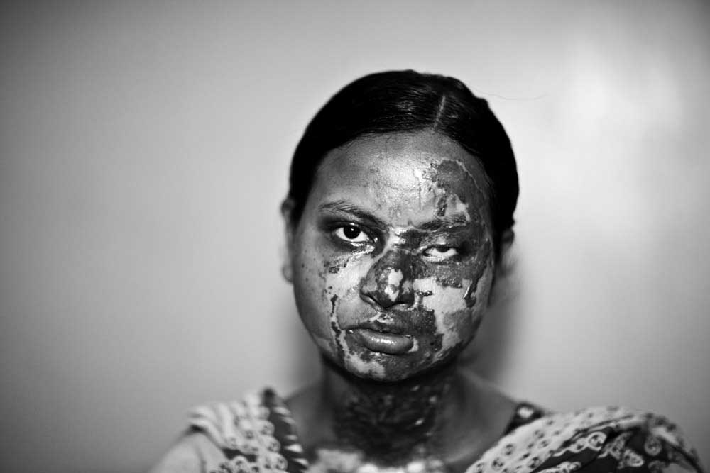 Acid Survivors by Jan Møller Hansen