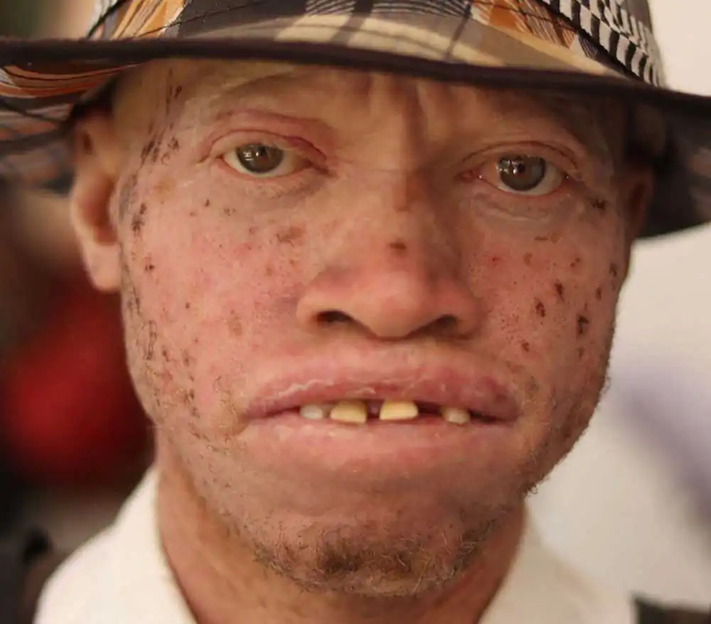 Albinism; Without colors by Antoine Janot